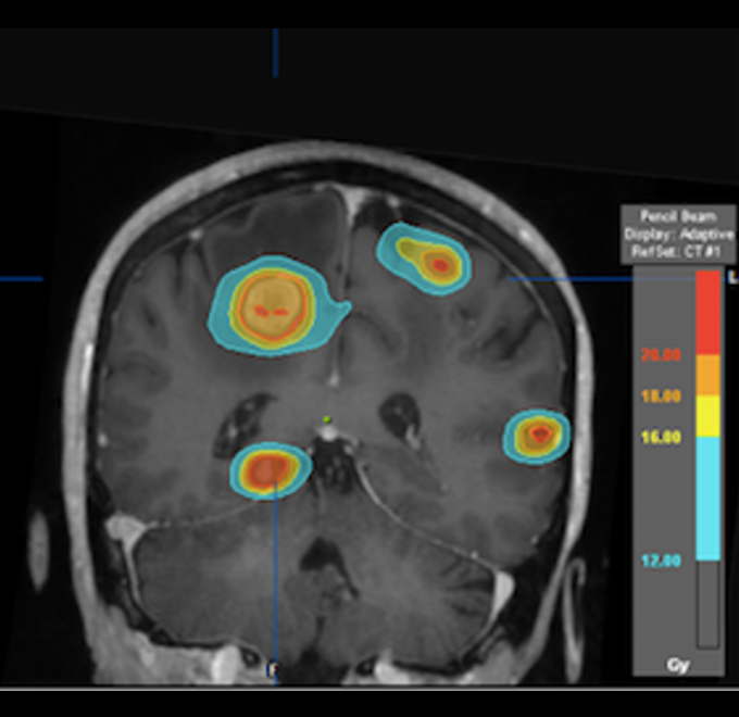 Radiocirugía intracraneal