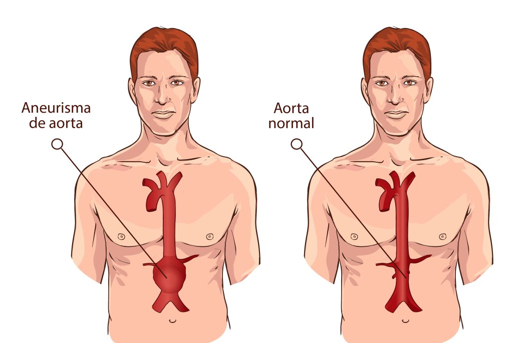 Aneurisma Diagrama