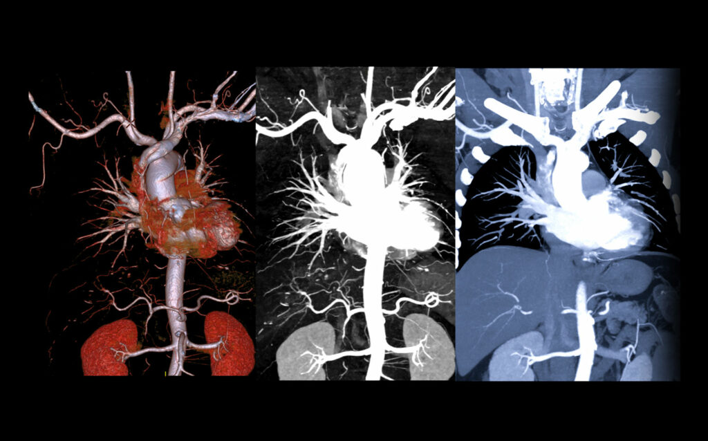 Aneurismas de aorta toracica