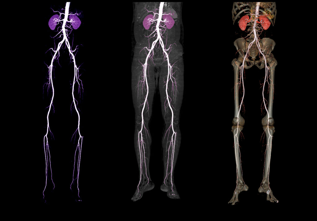 ﻿﻿Aneurismas de arterias periféricas