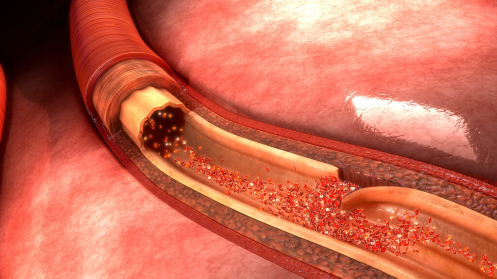 ﻿﻿diseccion aortica