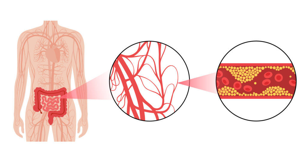 isquemia arterial