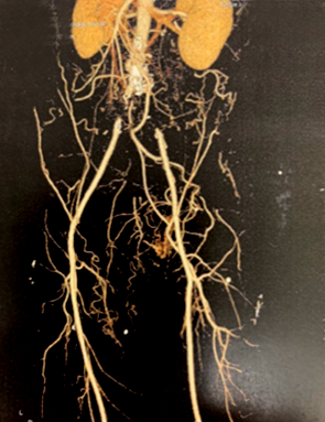 Tomografía enfermedad obstructiva aortoiliaca