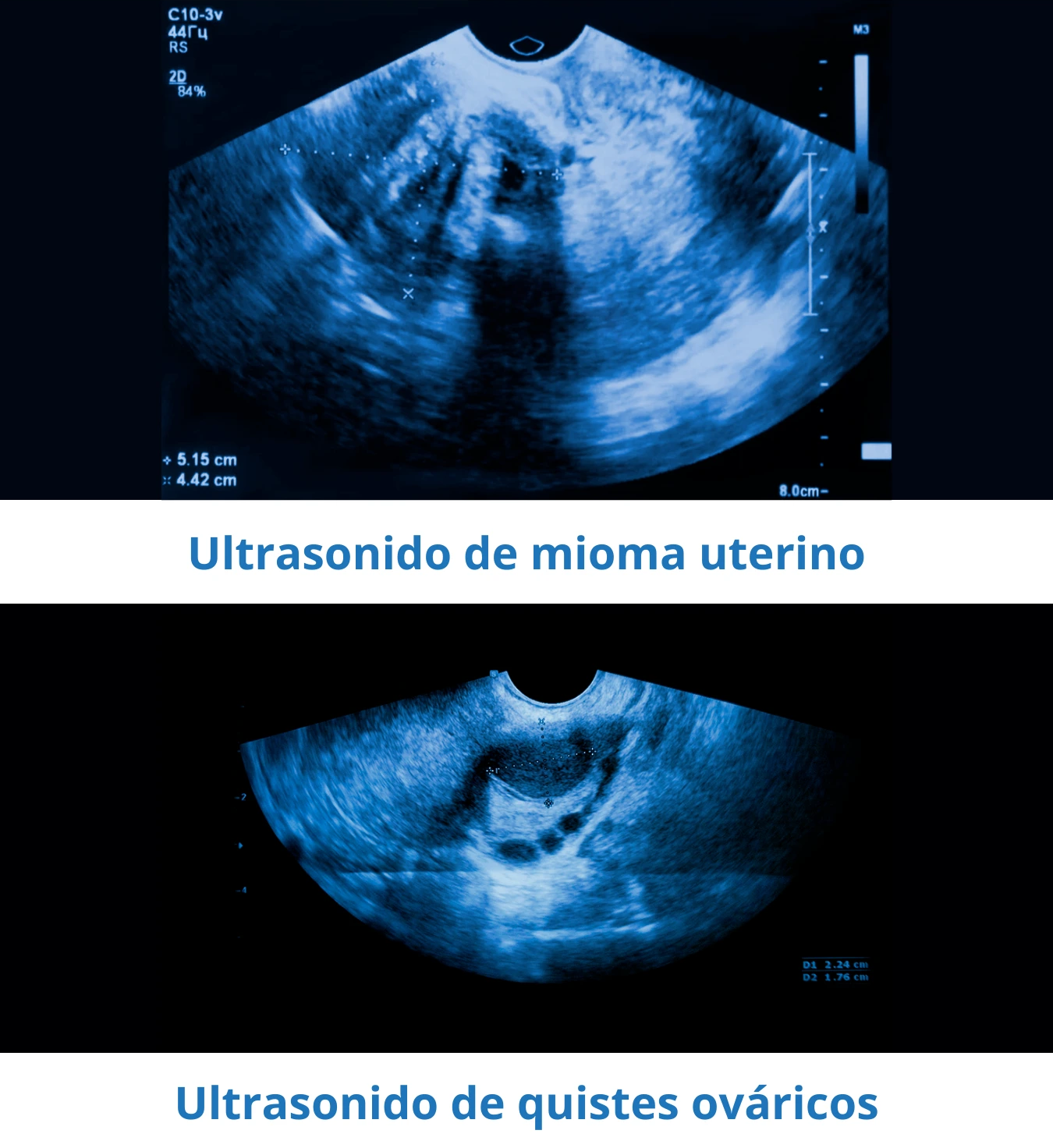 Ultrasonidos de miomas y quistes para su análisis e identificar el tratamiento adecuado para cada caso. Ultrasonidos de miomas y quistes para su análisis e identificar el tratamiento adecuado para cada caso.