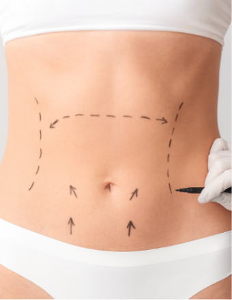 que-es-abdominoplastia Imagen ilustrativa de una mujer que se realizará una abdominoplastia