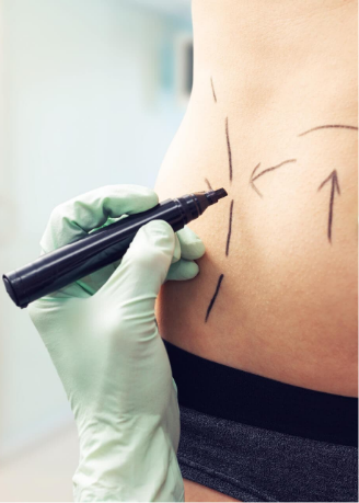 liposuccion-abdominal Mujer siendo retocada a traves de una liposuccion abdominal