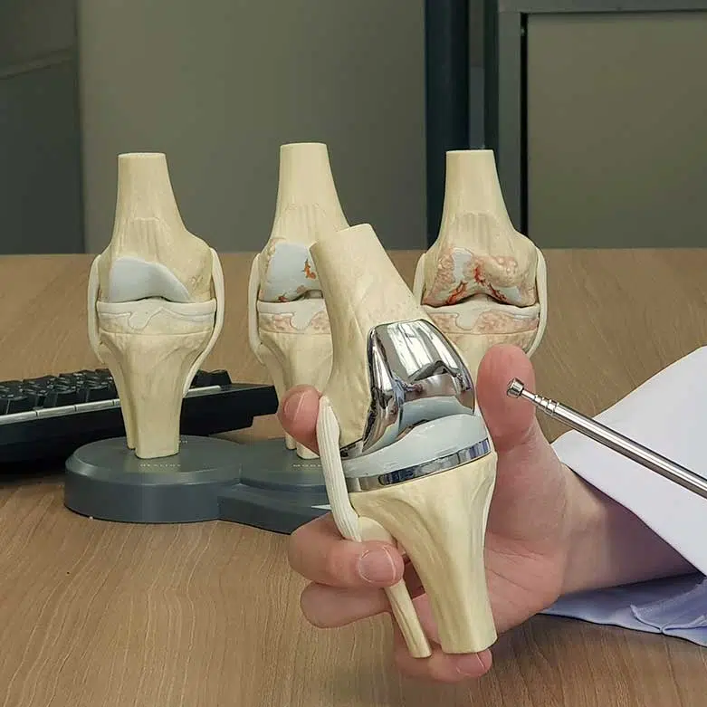 Prótesis de rodilla | Reemplazo de rodilla Prótesis de rodilla | Reemplazo de rodilla