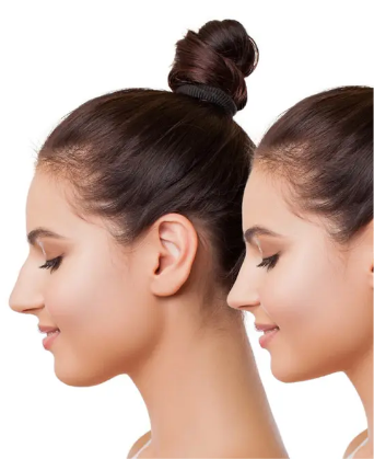 rinoplastia Imagen ilustrativa de una mujer antes y después de una rinoplastia