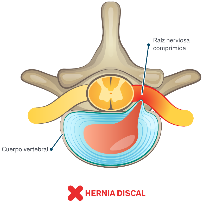 Hernias de disco: síntomas y causas Infografía ilustrada de una hernia de disco en la medula espinal
