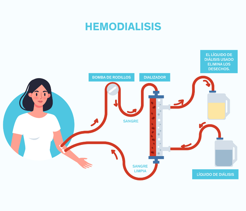 Hemodiálisis Diagrama