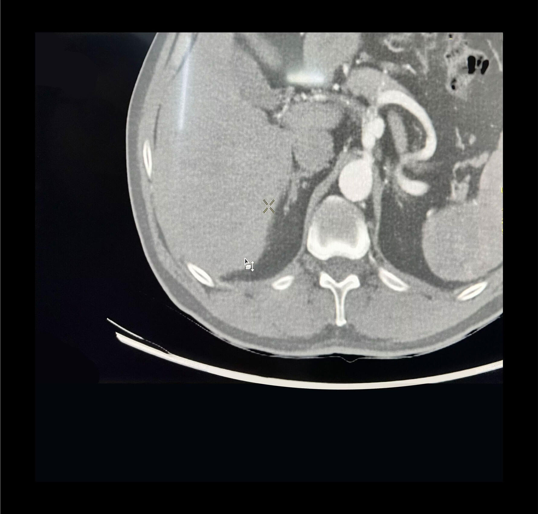 Aneurismas de arterias periféricas