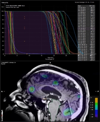 Pathologies can be treated with intracranial radiosurgery (SRS) Pathologies can be treated with intracranial radiosurgery (SRS)