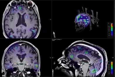 Stereotactic Radiosurgery (SRS) Stereotactic Radiosurgery (SRS)
