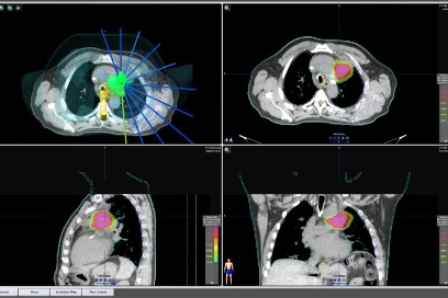 Stereotactic Body Radiation Therapy (SBRT) Stereotactic Body Radiation Therapy (SBRT)