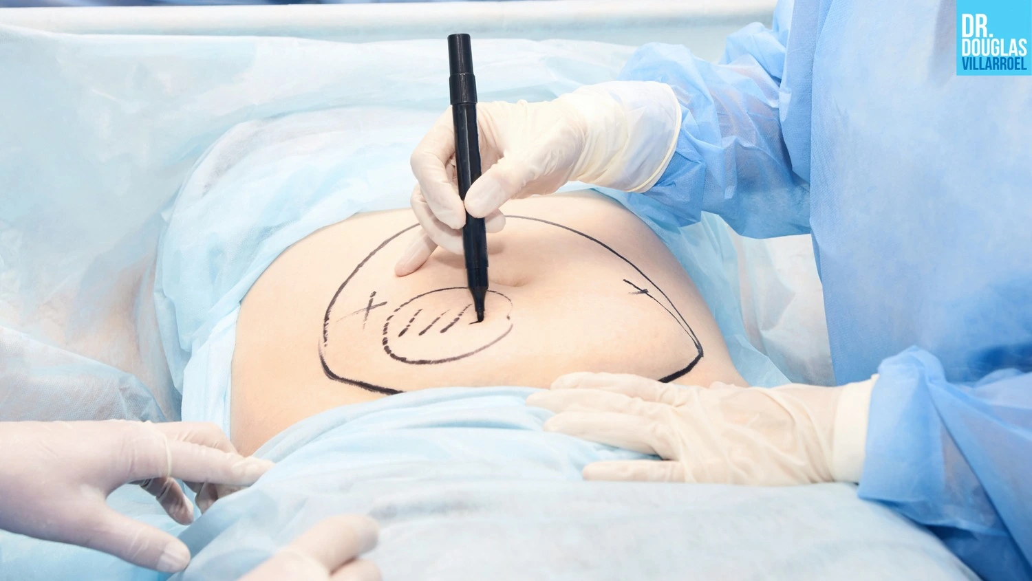 Médicos realizando marcación en el cuerpo de una paciente para realizar una histerectomía.