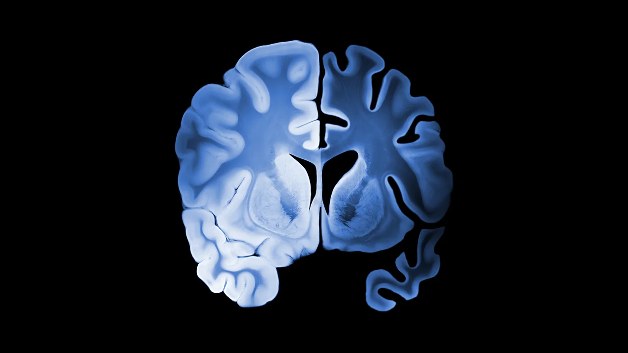 Ilustración del hemisferio izquierdo con Alzheimer, comparándolo con el hemisferio derecho sano de un cerebro.