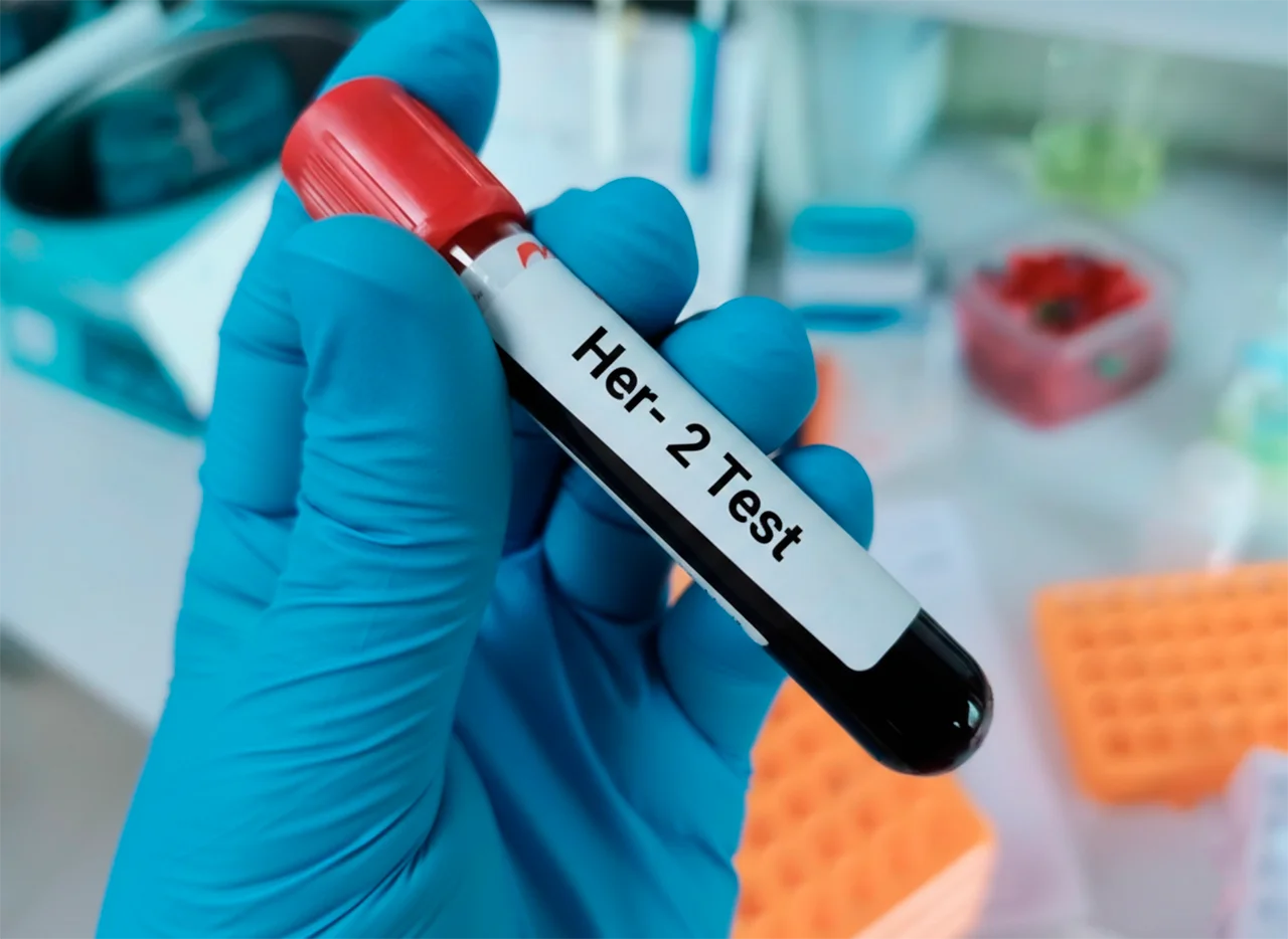 Tubo de ensayo, como parte del proceso diagnóstico de cáncer de mama, con muestra de sangre para el análisis de la proteína HER2.