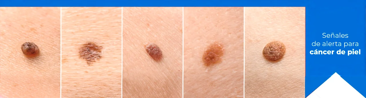 Diferentes fotos de cómo el cáncer de piel se puede presentar, para indicar las señales de alerta.