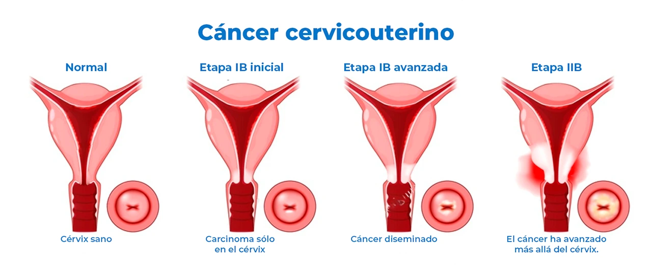Ilustración de las diferentes tapadas de la estadificación del cáncer cervicouterino desde un estado normal hasta la esparción.