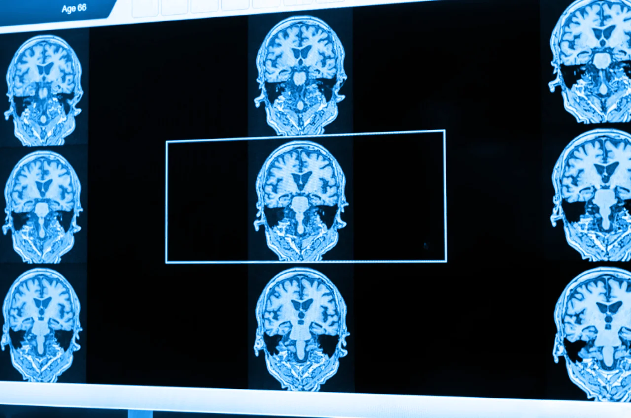 Resonancia magnética realizada en el diagnóstico de la demencia vascular para identificar el padecimiento de un paciente.