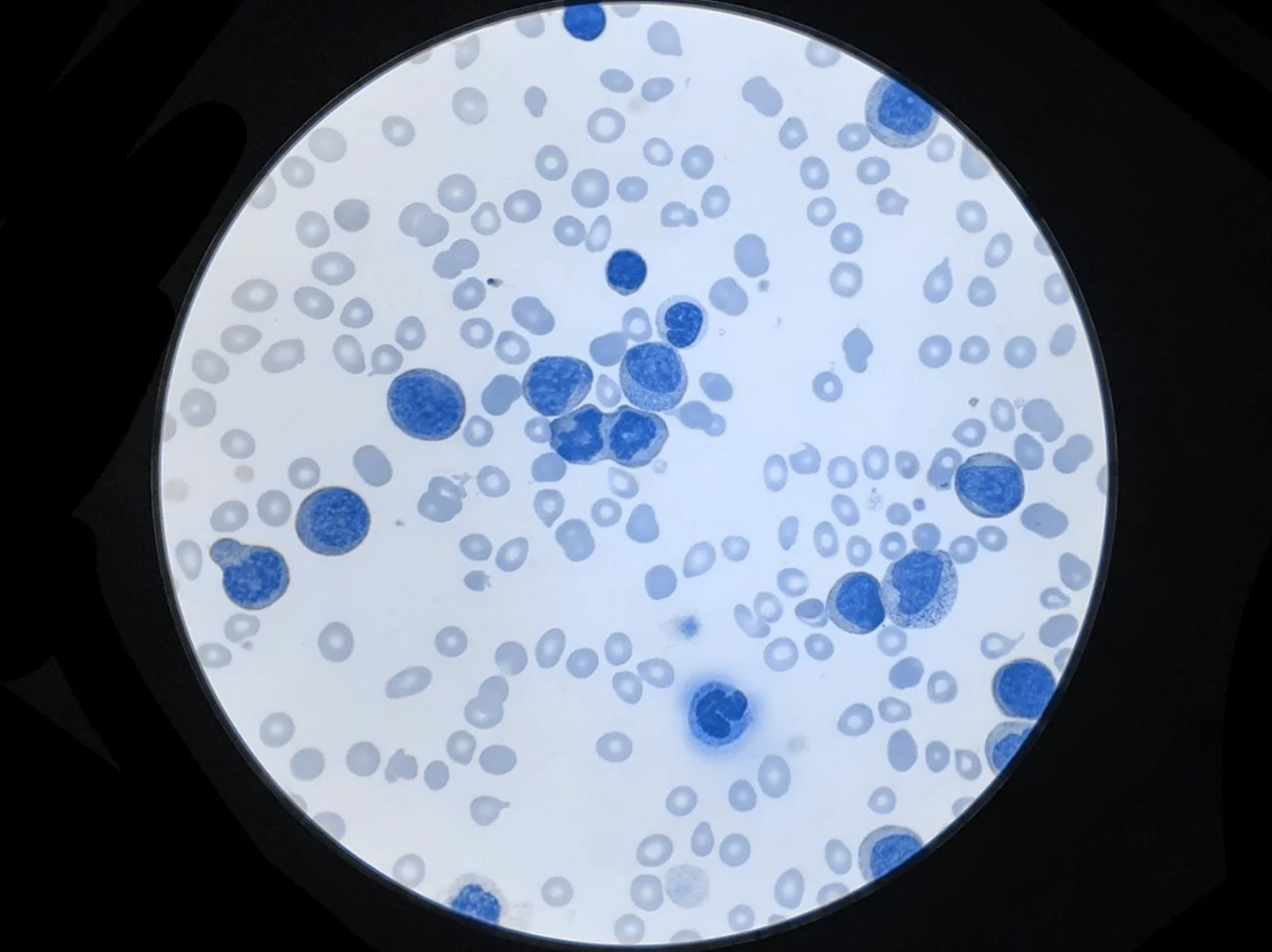 Célula de linfoma ampliada bajo un microscopio, como parte del estadio patológico para determinar las etapas del cáncer.