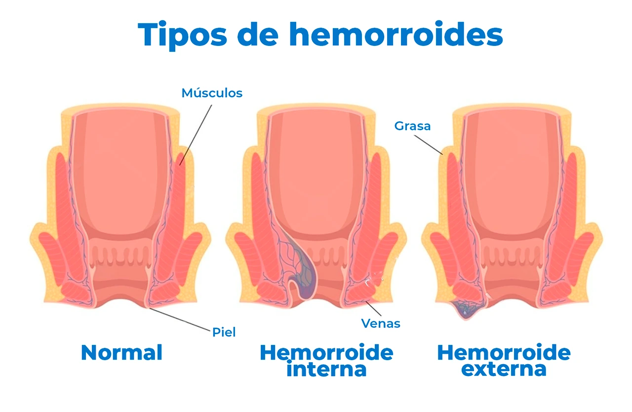 Ilustración que representa al momento de cómo curar las hemorroides, los diferentes tipos que hay.