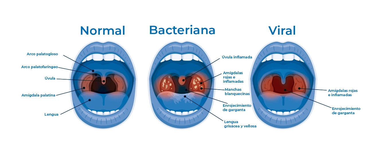 Ilustración sobre cómo se puede ver afectada la boca con una faringitis aguda, dependiendo de su origen viral o bacteriana.