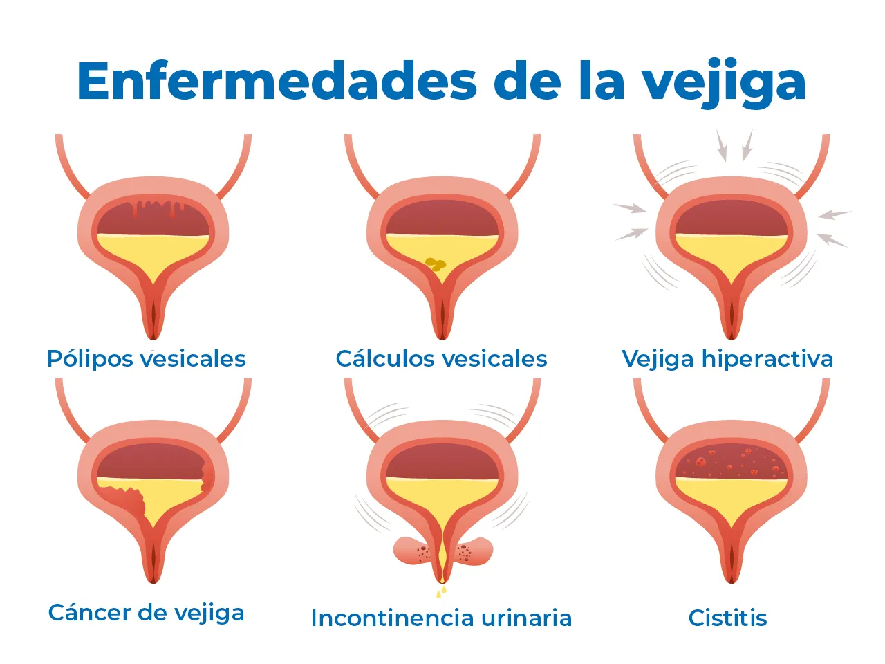 Ilustración de las enfermedades que el urólogo puede abordar en la vejiga, con seis ejemplos.