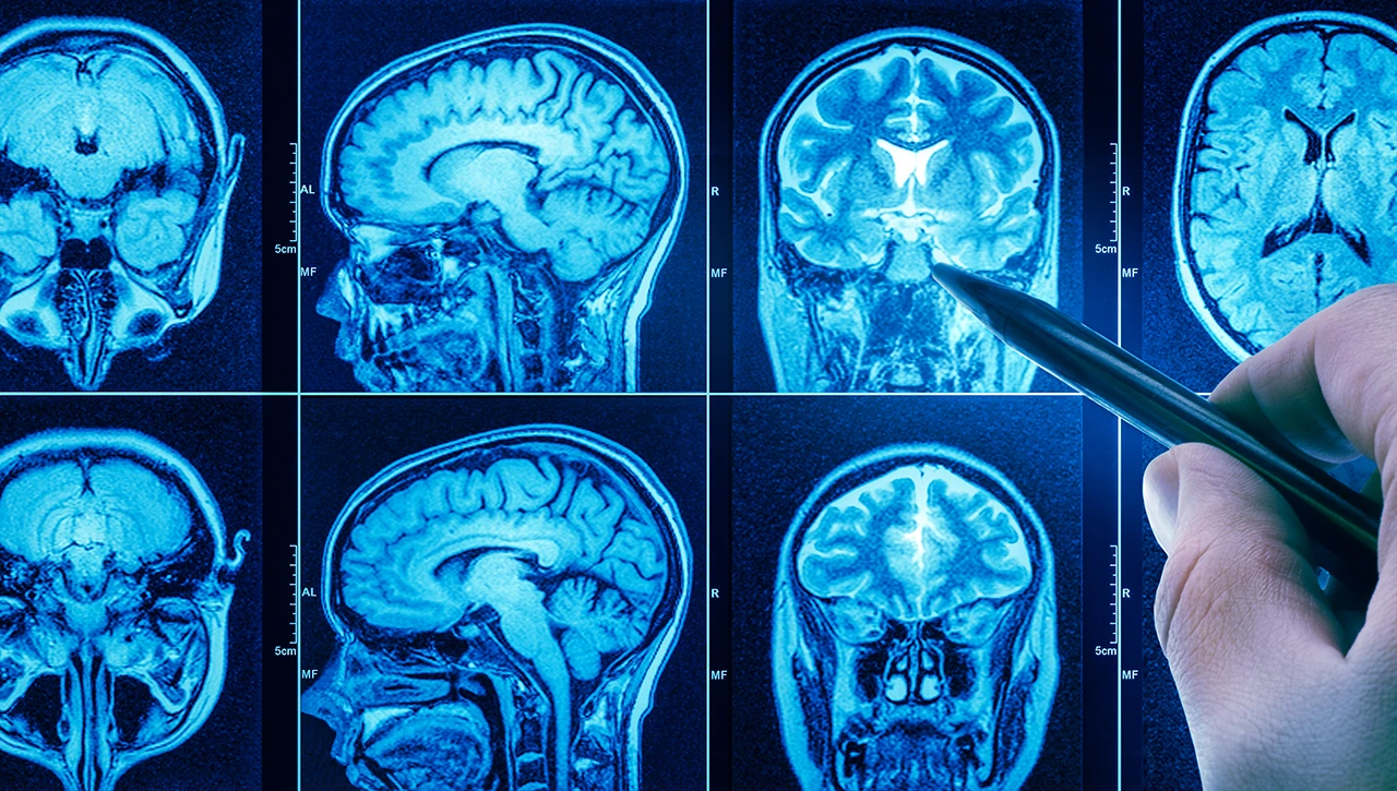 Tomografía realizada debido a la sospecha de cáncer cerebral, como parte de los estudios diagnósticos por imagen.