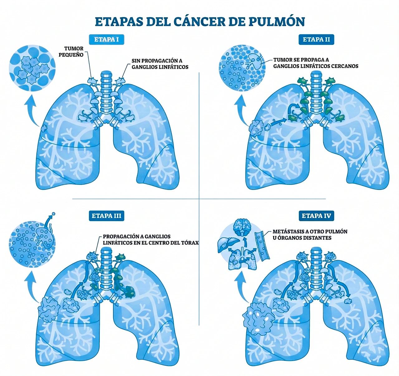 Ilustración que aborda en el cáncer de pulmón síntomas diversos, en función a las etapas de esta enfermedad.
