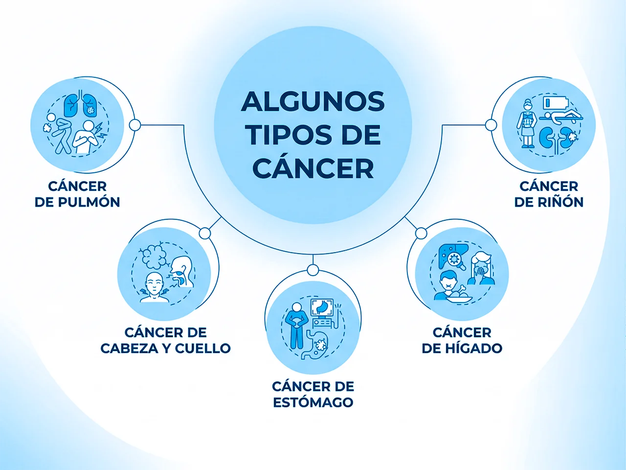 Infografía de diagrama sobre tipos de cáncer incluyendo cáncer de pulmón, cáncer de riñón, cáncer de cabeza y cuello, entre otros.