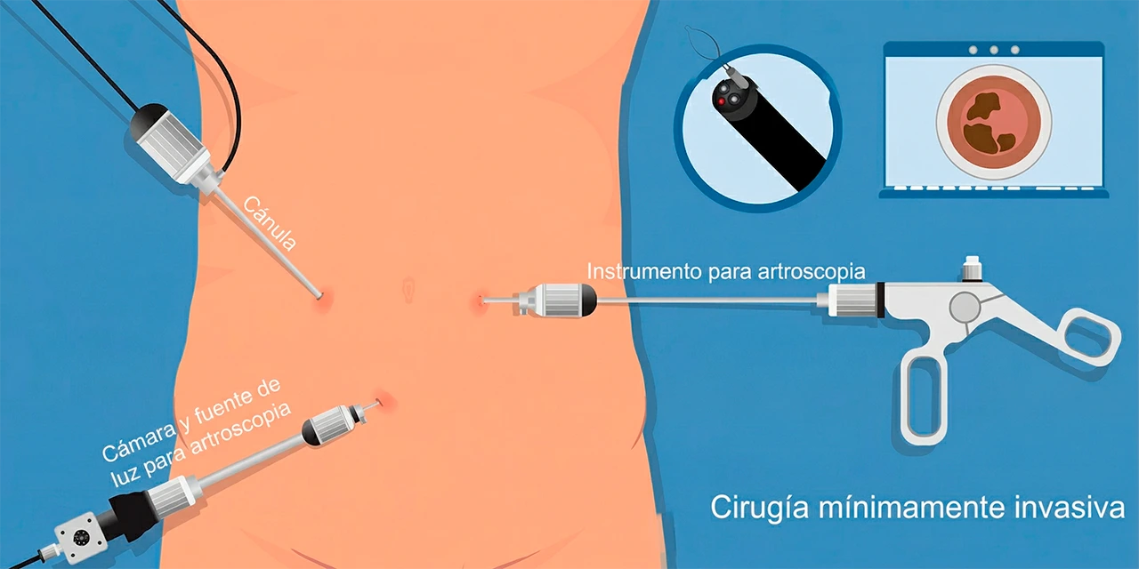 Ilustración de uno de los tipos de cirugía de mínima invasión, de una laparoscopia realizada en la zona abdominal.